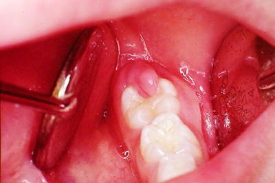 Viêm lợi răng hàm kiêng ăn gì? THAM KHẢO NGAY